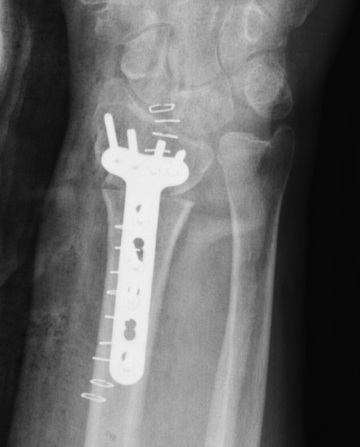 Radial Malunion Volar Opening Wedge Osteotomy